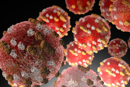 measles alert